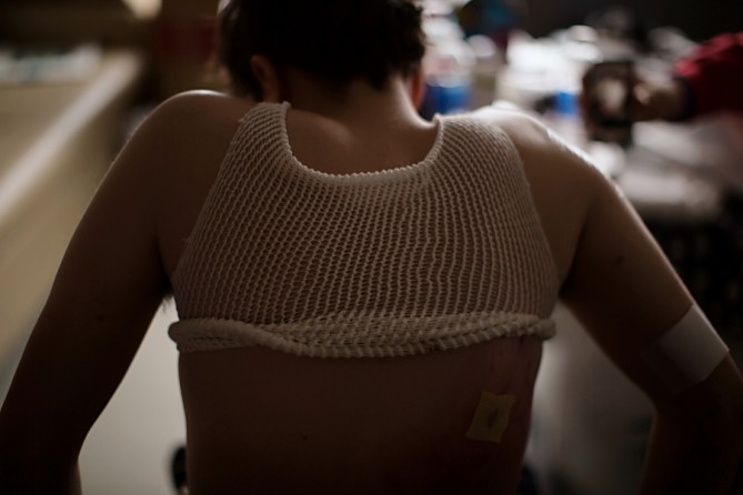 Bauman wore netting to keep his bandages in place. In addition to losing much of his legs, he sustained burns on his back and a deep puncture wound in his upper right arm. (Josh Haner, The New York Times - May 8, 2013)