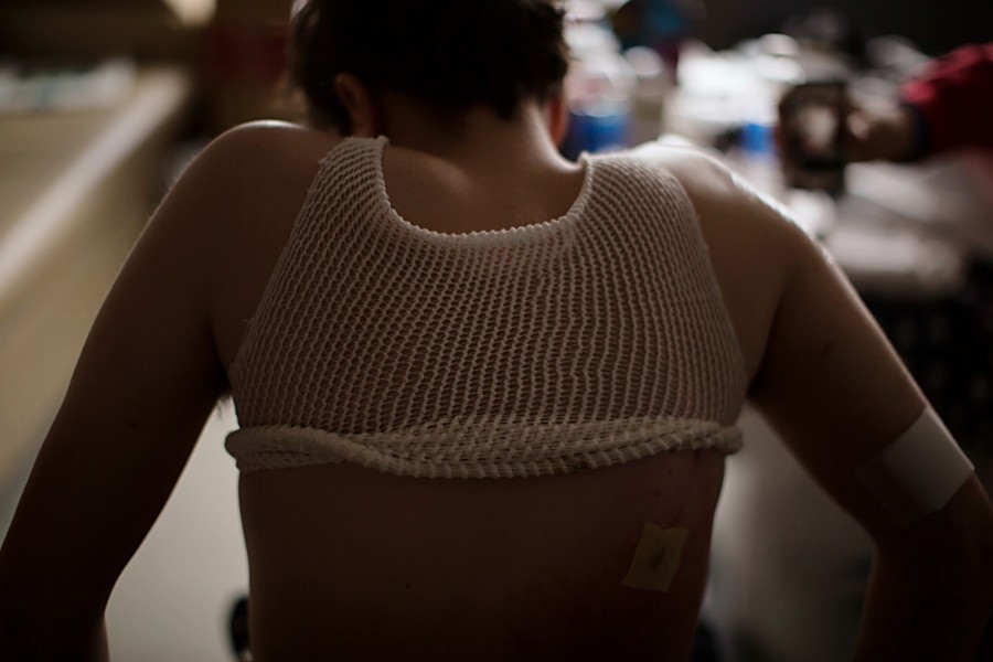 Bauman wore netting to keep his bandages in place. In addition to losing much of his legs, he sustained burns on his back and a deep puncture wound in his upper right arm. (Josh Haner, The New York Times - May 8, 2013)